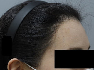 모발이식 전 / 수술 후 8개월 경과