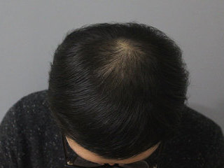 두피문신 정수리 시술 전 / 후