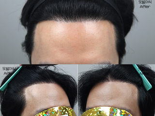 20대 남성 2500모 헤어라인 모발이식 12개월 경과