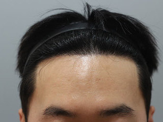 모발이식 전 / 수술 후 8개월 경과