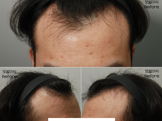 20대 남성 4400모 모발이식 8개월 경과