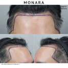무삭발 비절개 모발이식 3000모, 다음 날 출근 가능할까? 1년 경과와 회복 과정