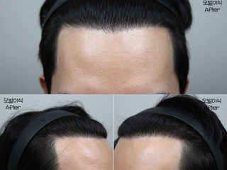 40대 남성 3000모 모발이식 1년 경과