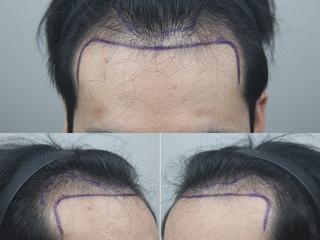 남자 앞머리 4400모 8개월 경과