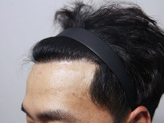 모발이식 전 / 수술 후 8개월 경과