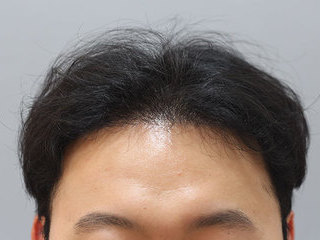 모발이식 전 / 수술 후 7개월 경과