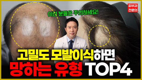 고밀도 모발이식의 기준, 고밀도 이식이 안되는 유형은?