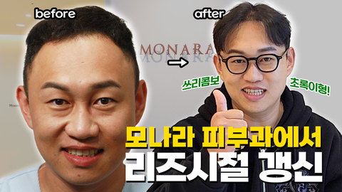 쓰리콤보 초록이형 M자 탈모 모발이식 1년,  리얼 후기 인터뷰!