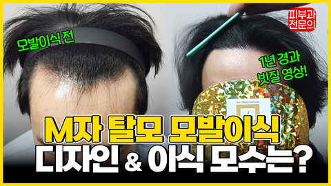 M자탈모 해결 법! 탈모 & 모발이식 피부과전문의가 알려드림????‍⚕