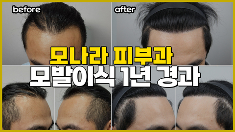 모나라피부과 비절개모발이식 1년 리얼 후기!