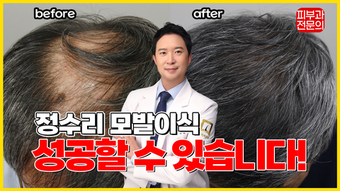 정수리 탈모 절대 포기하지 마세요! 정수리 모발이식 꿀팁 공개!