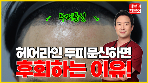 헤어라인 두피문신하면 후회하는 이유!